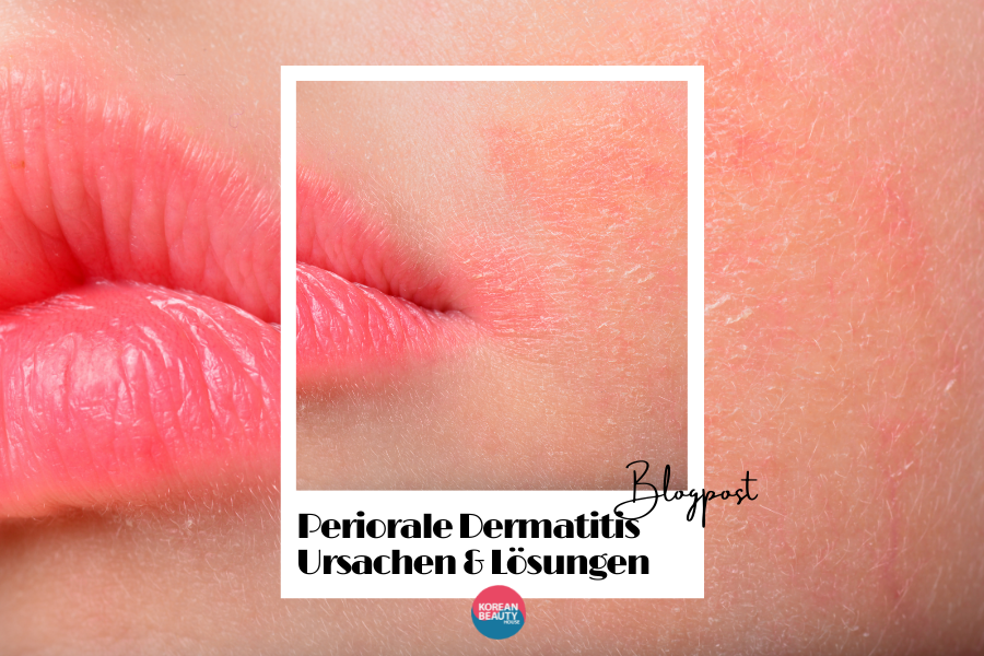 Periorale Dermatitis – Ursachen und Lösungen Periorale Dermatitis – Ursachen und Lösungen