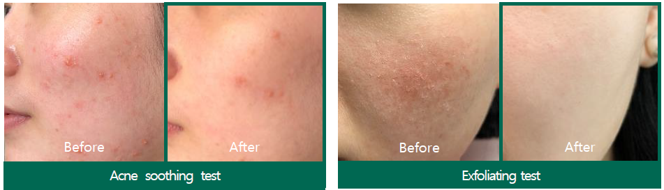 SOMEBYMI AHA-BHA-PHA Miracle Acne Clear Foam SOMEBYMI AHA-BHA-PHA Miracle Acne Clear Foam